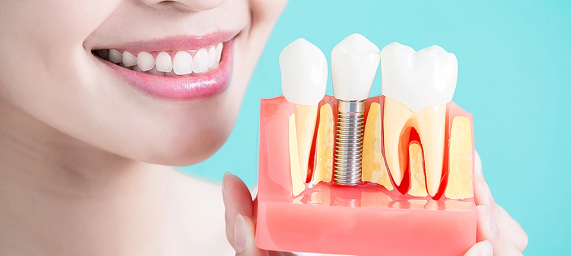 The best missing tooth replacement with quality, pain-free dental implants at College Road, Nashik